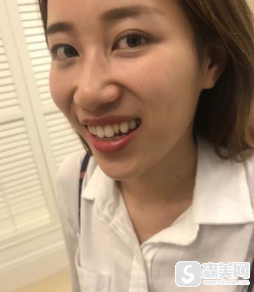 重庆诚嘉医院价目表2021,内含牙齿矫正果前后对比图