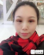 无锡伊尔美整形美容医院价格表，附全切双眼皮整形果前后对比图