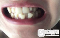 王明锋医生在牙齿正畸方面的造诣怎么样?做的的牙齿矫正果好不好?