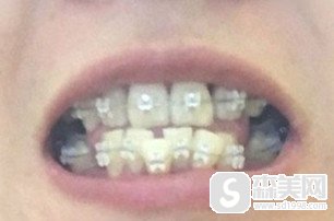 王明锋医生在牙齿正畸方面的造诣怎么样?做的的牙齿矫正果好不好?