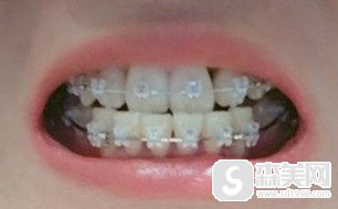 王明锋医生在牙齿正畸方面的造诣怎么样?做的的牙齿矫正果好不好?