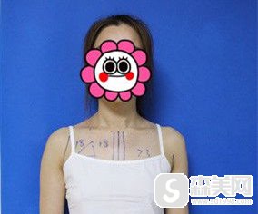 熊猛假体隆胸的技术好不好?假体隆胸果好吗?相关案例分享