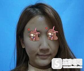 叶信海医生怎么样？附上海第十人民医院整形科介绍及叶信海医师隆鼻成功案例