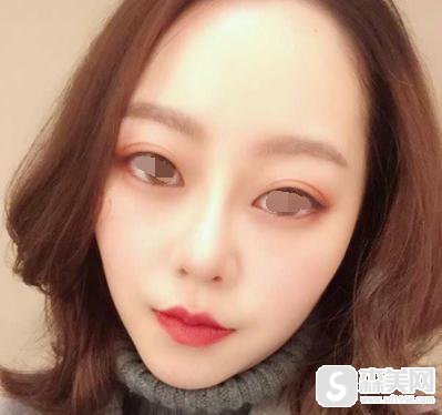 膨体隆鼻的价格?附膨体隆鼻案例+术前术后果对比图