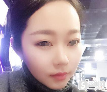 膨体隆鼻的价格?附膨体隆鼻案例+术前术后果对比图