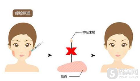 注射注射瘦脸要多少钱？附注射注射瘦脸案例分享+前后果图