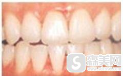 超声波洗牙多少钱?附超声波洗牙相关介绍及真实案例分享