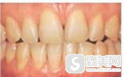 超声波洗牙多少钱?附超声波洗牙相关介绍及真实案例分享