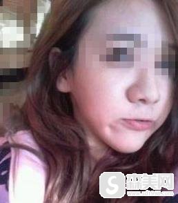 北京丽都医疗美容医院价目表2021,鼻翼缩小术的价格,内含鼻翼缩小术案例