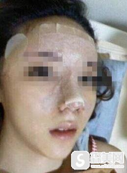 北京丽都医疗美容医院价目表2021,鼻翼缩小术的价格,内含鼻翼缩小术案例