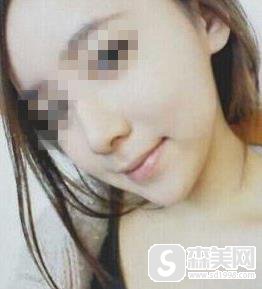 北京丽都医疗美容医院价目表2021,鼻翼缩小术的价格,内含鼻翼缩小术案例