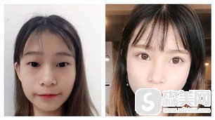 汕头曙光整形医院的技术优势怎么样/全切双眼皮的案例分享/双眼皮切割的价目表