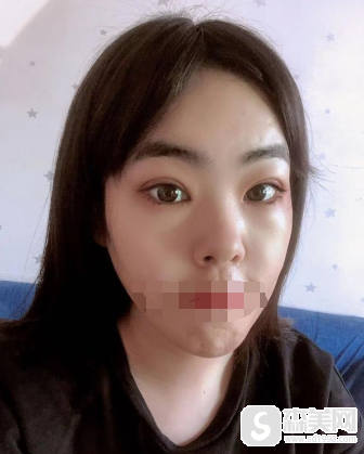 刘菲整形医生怎么样？附上海九院医院介绍及刘菲医生双眼皮案例