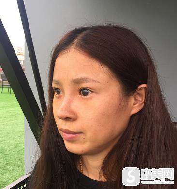 成都铜雀台整形医院价格表2020，鼻翼缩小术价钱，内附鼻翼缩小术果图