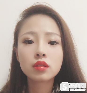 成都铜雀台整形医院价格表2020，鼻翼缩小术价钱，内附鼻翼缩小术果图