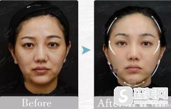 中日友好医院价目表2020,内含玻尿酸去除鱼尾纹果前后对比图