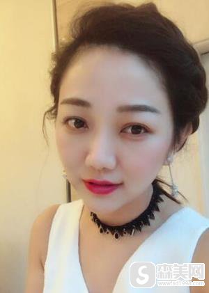 中日友好医院价目表2020,内含玻尿酸去除鱼尾纹果前后对比图