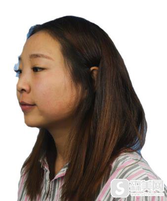 上海九院价目表2020,常雷整形医生隆鼻价格怎么样?内含隆鼻案例