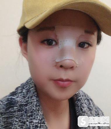 上海九院价目表2020,常雷整形医生隆鼻价格怎么样?内含隆鼻案例