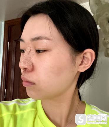 第四军医大学唐都医院价目表2021,内含陈辉整形医生假体隆鼻案例果前后对比图