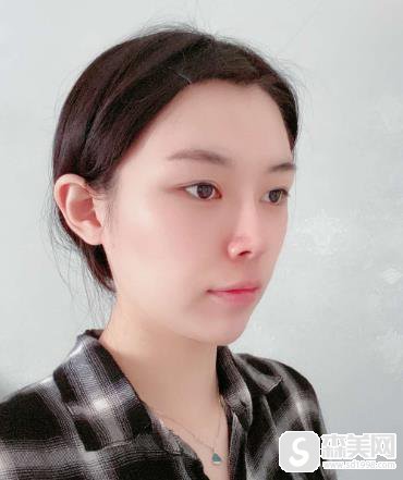 第四军医大学唐都医院价目表2021,内含陈辉整形医生假体隆鼻案例果前后对比图