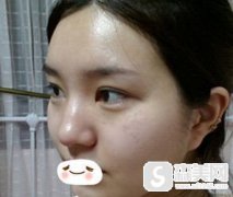 玻尿酸医生手法重要吗/注射玻尿酸后面部改变大吗/案例分享/价目表