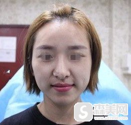 玻尿酸医生资质是怎么样的/玻尿酸注射案例分享/玻尿酸注射价目表