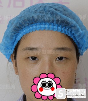 北京哪割双眼皮好/北京紫洁整形的双眼皮手术果怎么样/案例分享/附整形改变照片
