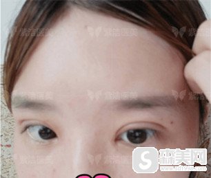 北京哪割双眼皮好/北京紫洁整形的双眼皮手术果怎么样/案例分享/附整形改变照片