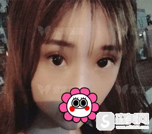 北京哪割双眼皮好/北京紫洁整形的双眼皮手术果怎么样/案例分享/附整形改变照片