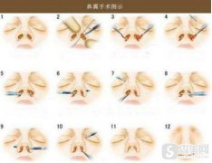 鼻翼缩小多少钱?附鼻翼缩小价格表一栏+鼻翼缩小成功案例分享