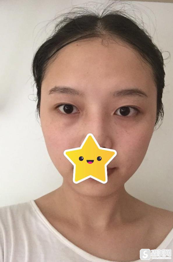 全切双眼皮费用怎么样？附双眼皮价格一栏及全切双眼皮整形案例分享