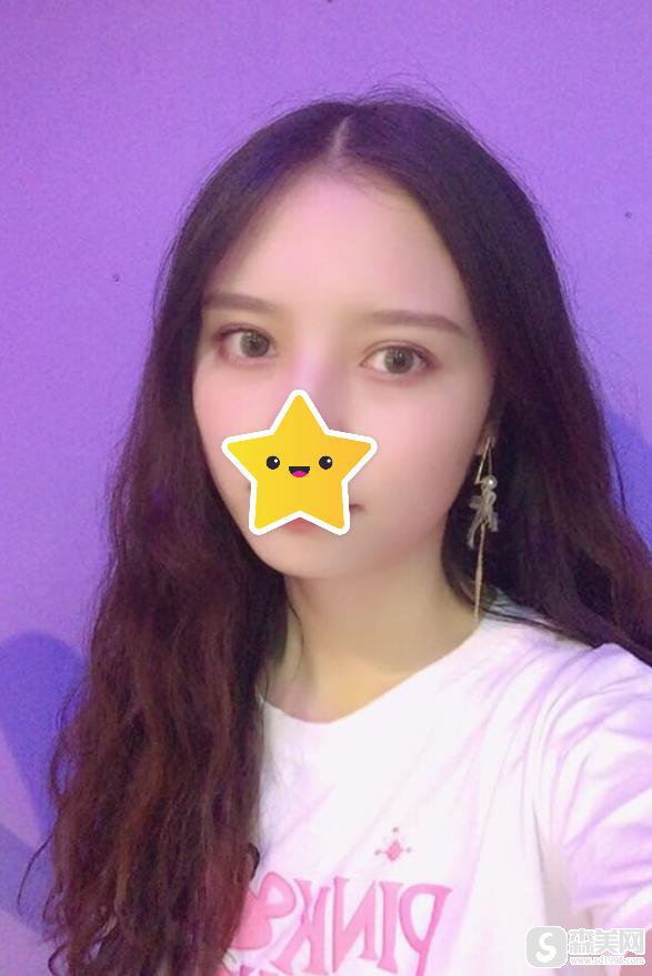 全切双眼皮费用怎么样？附双眼皮价格一栏及全切双眼皮整形案例分享