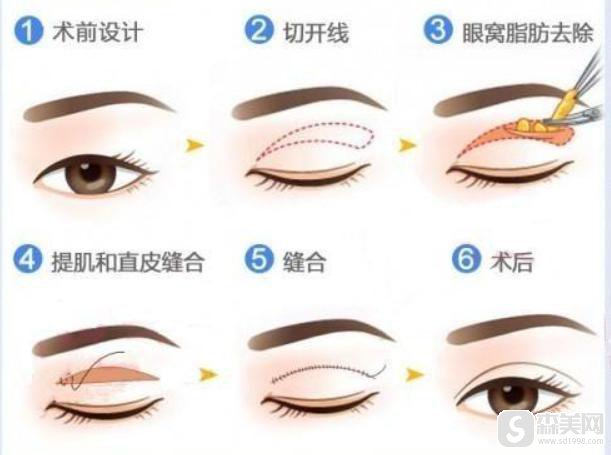 全切双眼皮费用怎么样？附双眼皮价格一栏及全切双眼皮整形案例分享