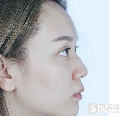 驼峰鼻整形要多少钱?驼峰鼻整形果怎么样?附驼峰鼻介绍级案例分享