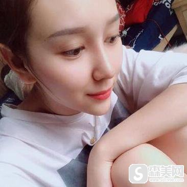 驼峰鼻整形要多少钱?驼峰鼻整形果怎么样?附驼峰鼻介绍级案例分享