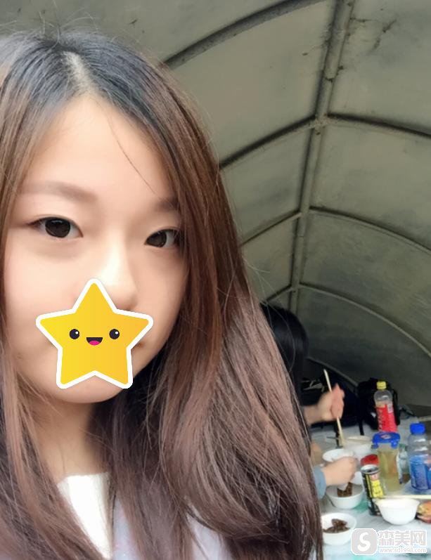 刘伟医生做双眼皮专业吗?附刘伟医生简介及双眼皮案例分享