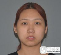 广州医科大学附属第五医院医疗美容外科价目表2021，内含面部吸脂案例果图