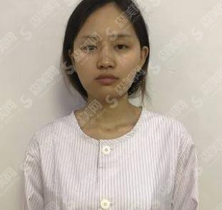 汕头大学医学院第一附属医院整形美容外科价格表2020,内含面部吸脂真人案例果图