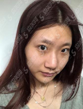 上海和睦家新城医院整形外科价目表2021,隆鼻价格,内含隆鼻真实案例