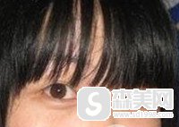 蒙古褶是怎么回事/蒙古褶的去除案例分享/蒙古褶果怎么样/蒙古褶的前后对比图