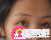 蒙古褶是怎么回事/蒙古褶的去除案例分享/蒙古褶果怎么样/蒙古褶的前后对比图