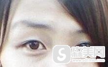 蒙古褶是怎么回事/蒙古褶的去除案例分享/蒙古褶果怎么样/蒙古褶的前后对比图