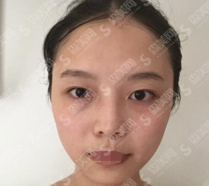 杨明勇医生双眼皮真实案例介绍,附成都八大处医院的介绍