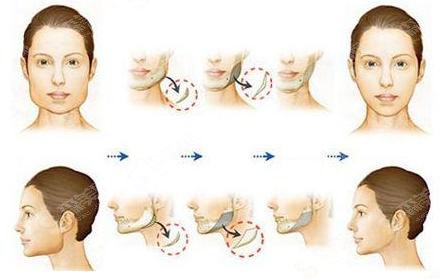 注射瘦脸多少钱？贵不贵？内附注射瘦脸案例+前后果对比图