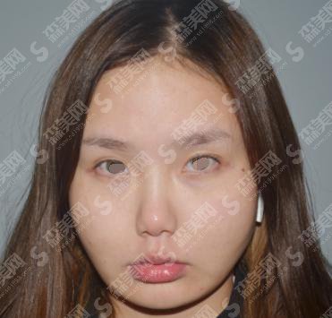 注射瘦脸多少钱？贵不贵？内附注射瘦脸案例+前后果对比图