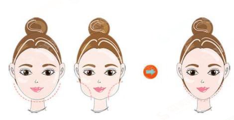 注射瘦脸多少钱？贵不贵？内附注射瘦脸案例+前后果对比图