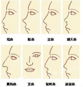 驼峰鼻整形的价格?靠谱吗?附驼峰鼻案例+前后果对比图
