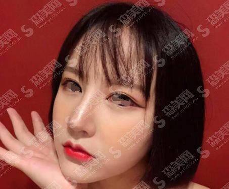 驼峰鼻整形的价格?靠谱吗?附驼峰鼻案例+前后果对比图