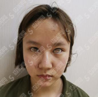 驼峰鼻整形的价格?靠谱吗?附驼峰鼻案例+前后果对比图